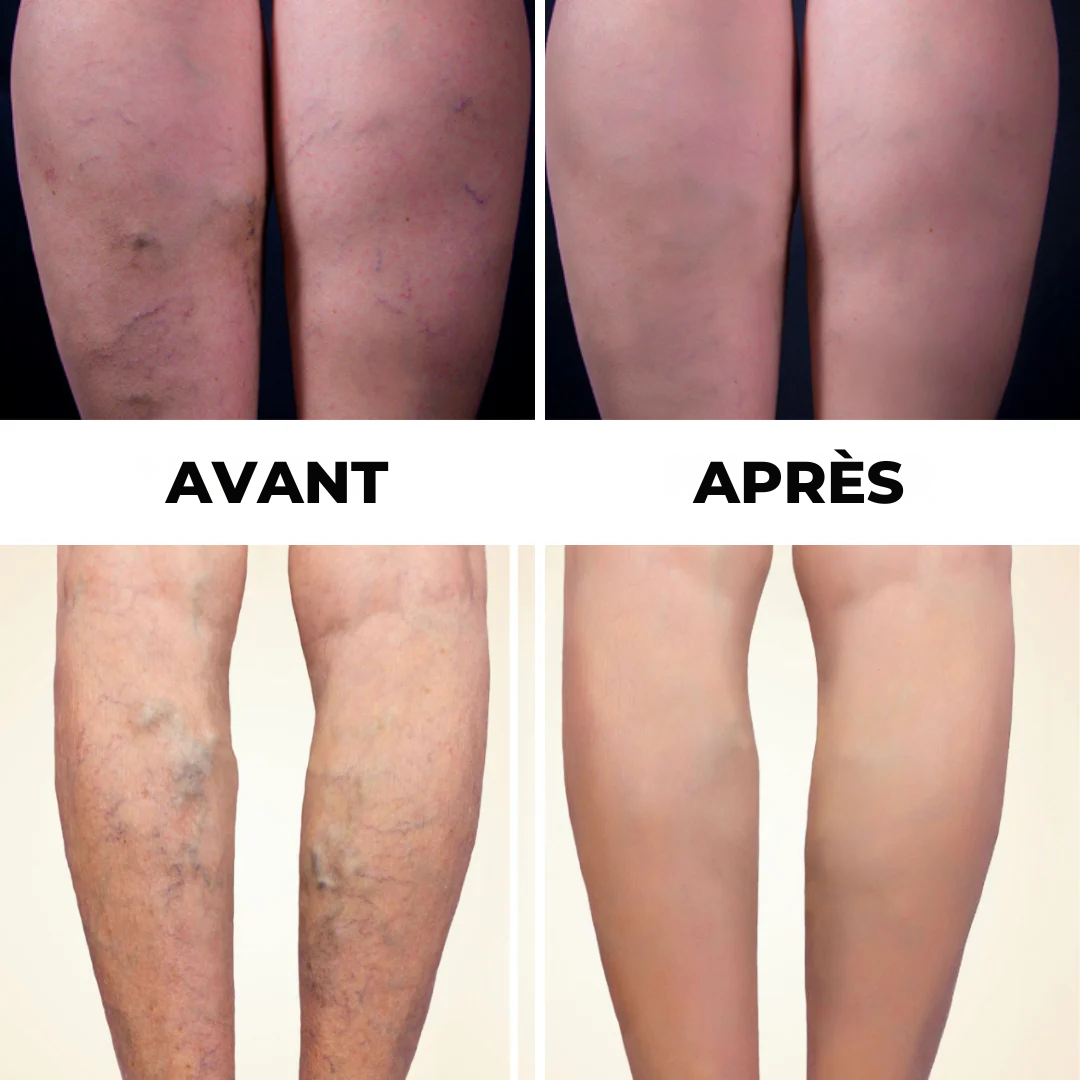Libérez vos jambes des gonflements en 15 min